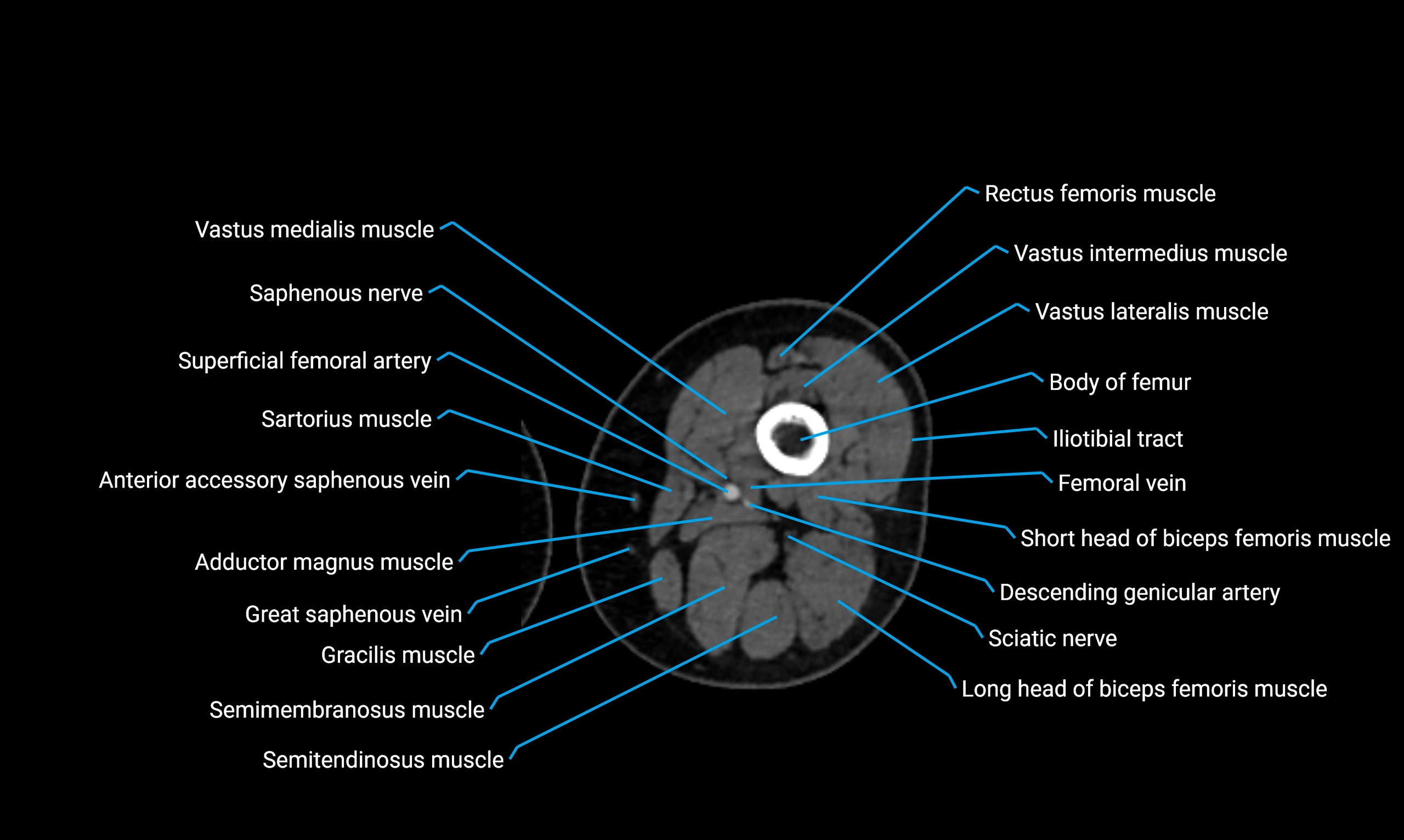 CT thigh axial cross sectional anatomy labelled image_61 (2).webp